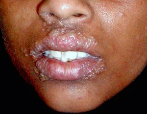 Illustration for article titled Pengobatan Penyakit Herpes